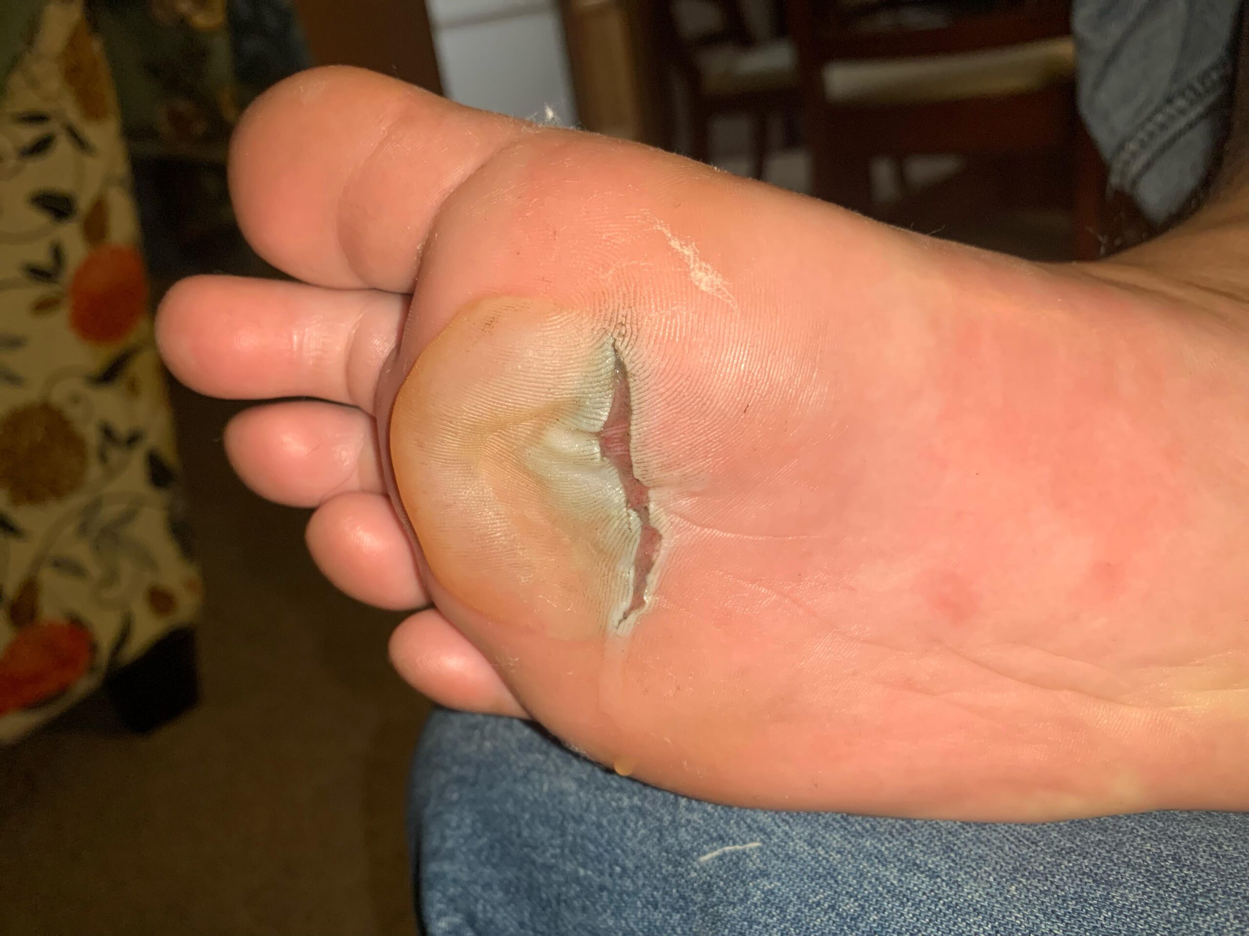 ampoule gros orteil course a pied